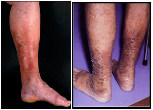 symptoms of varicose veins