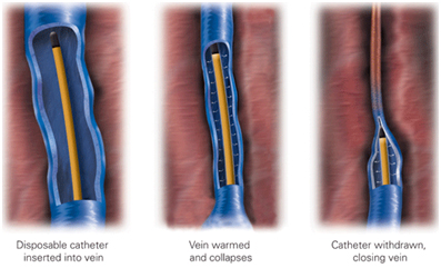 treatment option of varicose veins