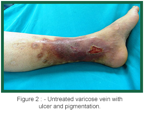 Varicose Venous ulcer