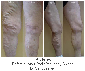 Non-Surgical treatment for Varicose Veins - Radio-frequency Ablation